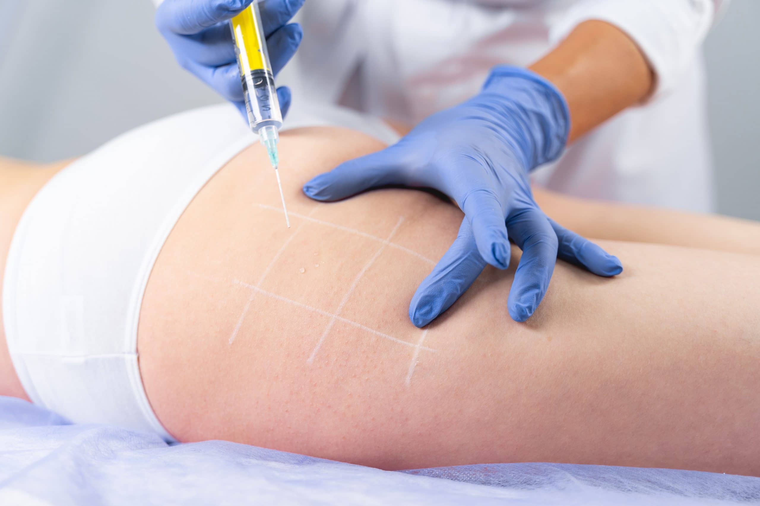 Thigh Fat Reduction